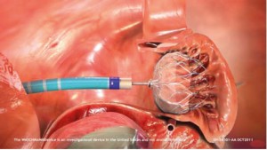 Figure 1. Left atrial appendage occluder device.