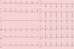 Figure 1. Electrocardiogram revealed synus rithm at 82 bpm, QRS axis at +37°, and non-specific ST-T changes.