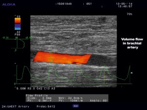 Figure 1. Duplex ultrasound imaging of the flow in the brachial artery supplying the hemodialysis fistula. Volume flow = 104 ml/min, at a beam angle = 60°.