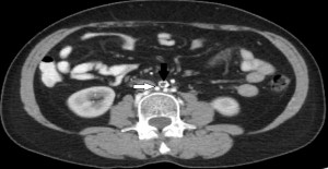 Figure 1. Abdominal-pelvic computed tomography with dye. We observe the presence of parietal aortic calcifications arrange circumferentially, the absence of contrast uptake in the terminal aorta lumen (black arrow) and significant dilation of lumbar arteries (white arrow).