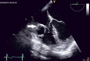 Figure 1. TEE examination, 4 chamber view; an echo free circular structure (1.8/2.2 cm in size) can be seen in the right ventricle, just beneath the tricuspid valve (arrow).