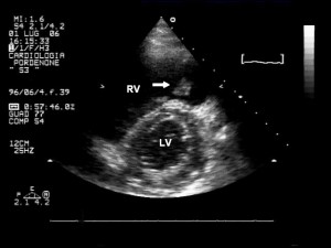 Figure 2. Transthoracic echocardiogram; left parasternal short axis at papillary muscles revealed a mild right ventricle dilation and a diastolic flattening of the interventricular septum which is consistent with elevated right heart pressures. We also observed a mobile mass attached to the pulmonary valve (arrow) which was oscillating between right ventricular outflow tract and pul­monary artery (compatible with a thrombus). RV- right ventricle, LV – left ventricle.