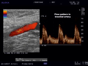 Figure 2. Color Doppler ultrasound of the brachial supplying artery indicating low-pulsatility pattern.