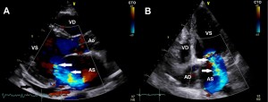 Figure 2. Transthoracic echocardiography, color Doppler examination. The parasternal sections on the long axis (a) and apical 4 chambers (B). Dilation of the Left Ventricle (LV) is observed (48 mm in systole) , dilation of the Left Atrium (LA) (44/56 mm) and the presence of a severe mitral regurgitation with eccentric jet oriented to the postero-lateral wall of LA (white arrow). In the pericardium, small amount of liquid (black arrow). LA, left atrium; LV, left ventricle; RV, right ventricle; RA, right atrium; Ao, ascending aorta.