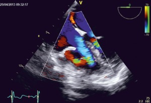 Figure 2. TEE examination, 4 chamber view; TEE reveals an abnormal turbulent flow at color Doppler examination at the level of this circular structure located in the right ventricle.