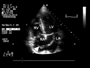 Figure 3. Transthoracic echocardiogram—apical four chambers view. Large serpentine and mobile thrombus (arrow) in right atrium passing through a patent foramen ovale into the left atrium. RV- right ventricle, RA – right atrium, LV- left ventricle, LA – left atrium.