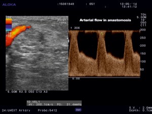 Figure 3. Color Doppler ultrasound of the brachial supplying artery at the level of anastomosis.