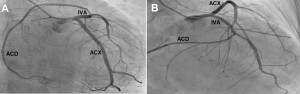 Figure 3. Coronary angiography. A. The incidence of caudal RAO. The incidence of cranial PA. The right coronary artery (RCA) originates in the second segment of the anterior interventricular artery (AIA). The circumflex artery (CXA) is free.