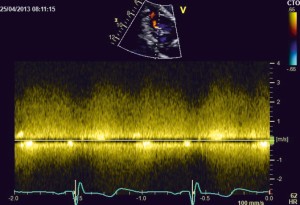 Figure 3. TTE examination, modified 4 chamber view; A continuous systo­lic-diastolic flow signal with high velocities (up to 4 m/s) was recorded by CW Doppler at the level of the turbulent jet.