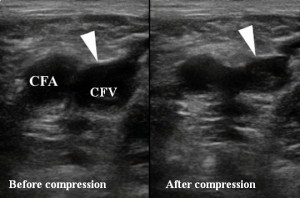 Figure 4. Duplex ultrasonography of the right femoral vein—lack of compressibility suggesting thrombosis. CFA—common femoral artery, CFV—common femoral vein.