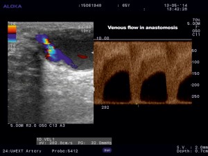 Figure 4. Color Doppler ultrasound of the cephalic vein at the level of anastomosis.