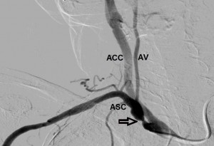 Figure 4. Angiography of brachicephalic trunk. It reveals the presence of proximal tight stenosis of the right subclavian artery (arrow). RSA, right subclavian artery; VA, right vertebral artery; CAA, right common carotid artery.