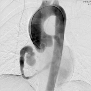 Figure 4. Coronary angiogram, aortic root injection, left anterior oblique caudal projection. A single coronary artery is seen arising from the left coronary sinus and terminating into the right ventricle through a coronary-cavity fistula. The dilatation of this single coronary artery can be easily appre­ciated.