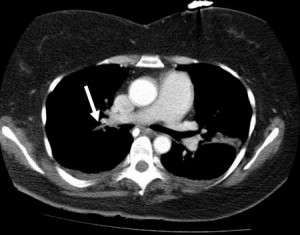 Figure 5. CT angiogram—an intraluminal filling defect which suggests that the right pulmonary artery was occluded (arrow).