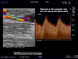 Figure 5. Color Doppler ultrasound of the cephalic vein. Stenosis at 2 cm above elbow joint.