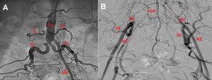 Figure 5. Angiography of terminal aorta. The terminal aorta is occluded, the common iliac arteries (CIA) are distal refilled bilaterally, the external iliac arteries (EIA) and internal iliac arteries (IIA) by collaterals developed from the lumbar arteries (LA), inferior mesenteric artery (IMA) and anterior sacral artery (ASA).