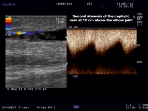 Figure 6. Color Doppler ultrasound of the cephalic vein. A second stenosis was identified at 12 cm above elbow joint.