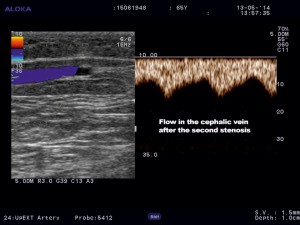 Figure 7. Color Doppler ultrasound of the cephalic vein after the second stenosis.