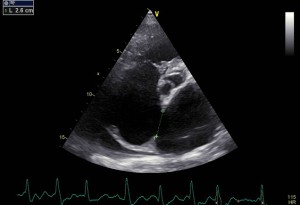 Figure 1. TTE examination, modified 4 chamber view, reveals an ostium secundum ASD with a maximum diameter of 26 mm.