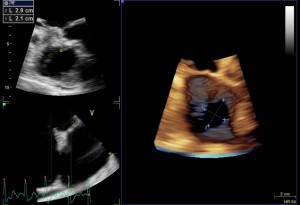 Figure 2. 3-dimensional TTE. "En face" volume ren­dering view of the ASD (right panel) visualised from the left atrium, with 29/21 mm diameters.