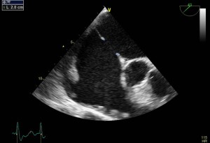 Figure 3. TEE exam confirms the ostium secundum ASD with a maximum diameter of 20 mm in this view.