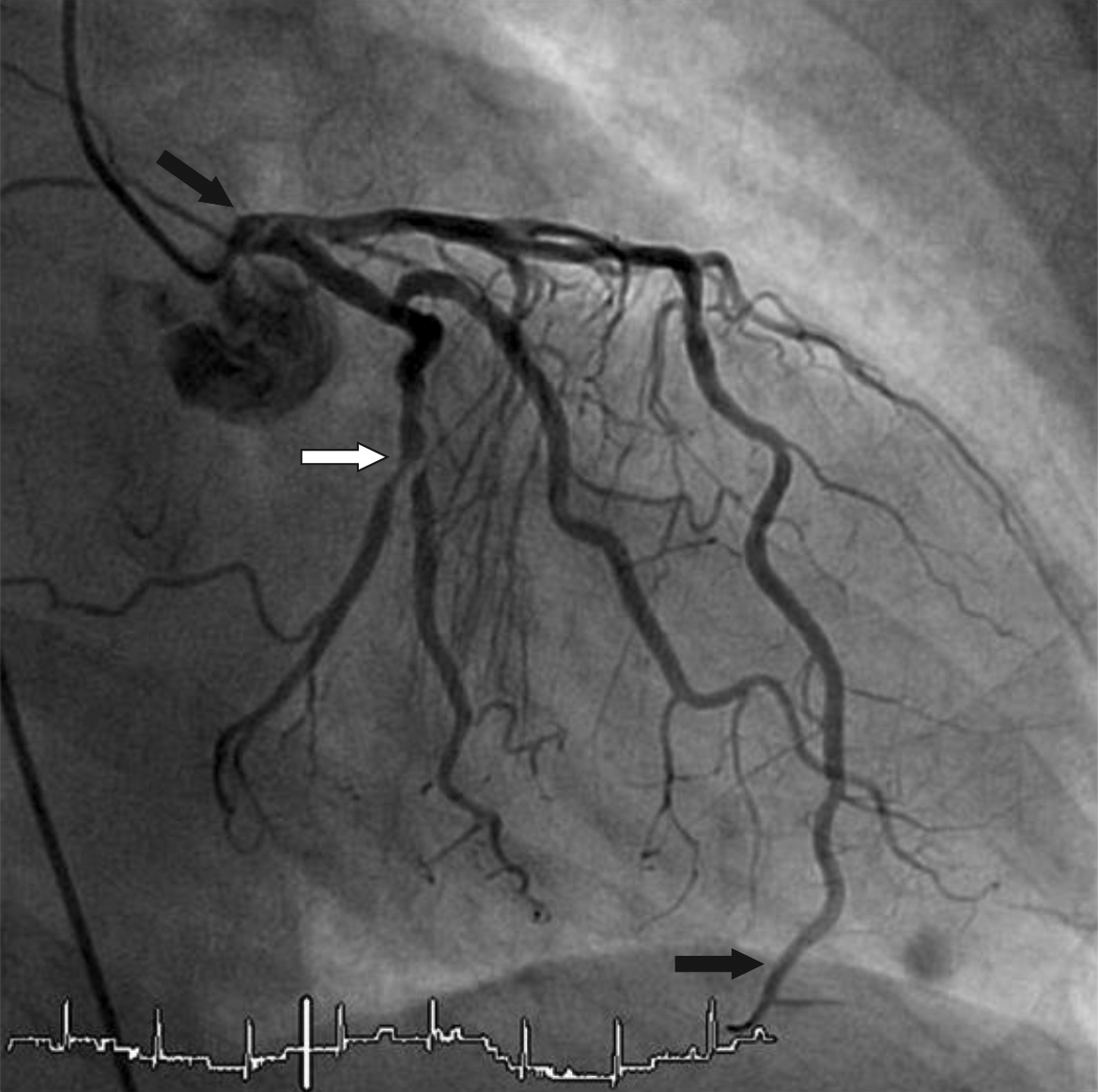 Culprit The analysis of coronary flow on non-culprit coronary arteries in Acute ...