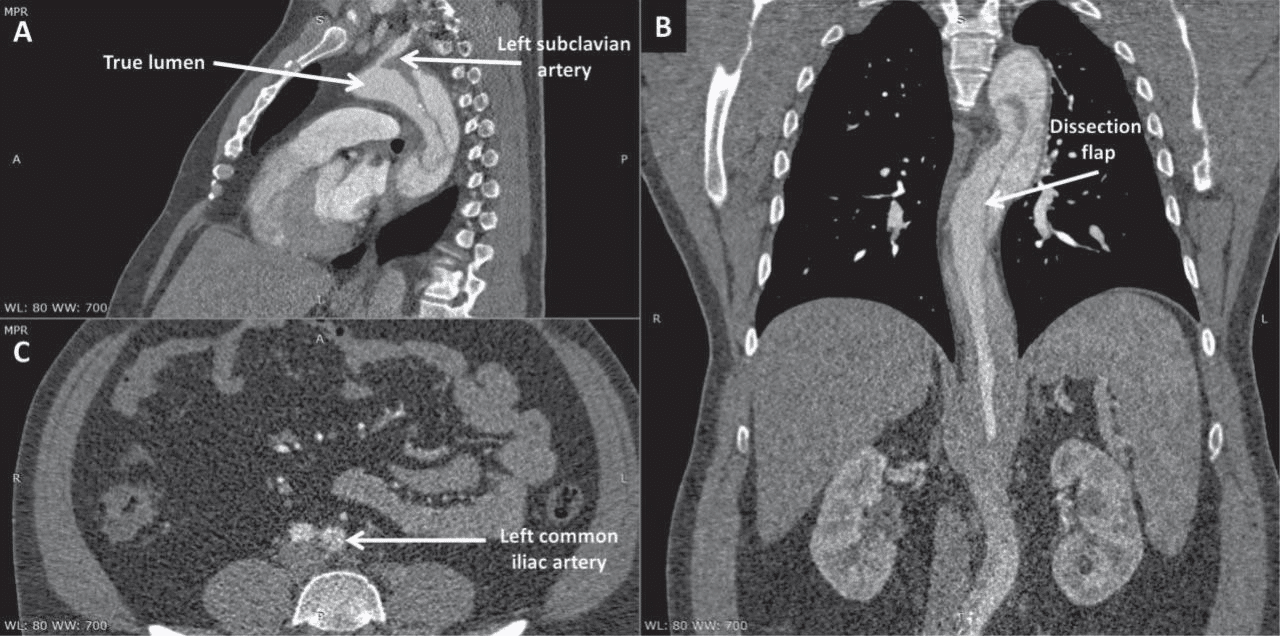 Stent Dissection Uncomplicated acute Stanford B aortic dissection treated by stent ...