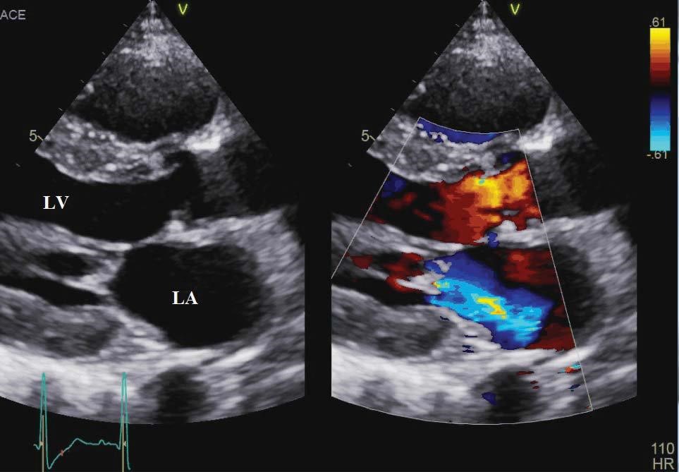 Secondary ischemic mitral regurgitation in a young patient ...